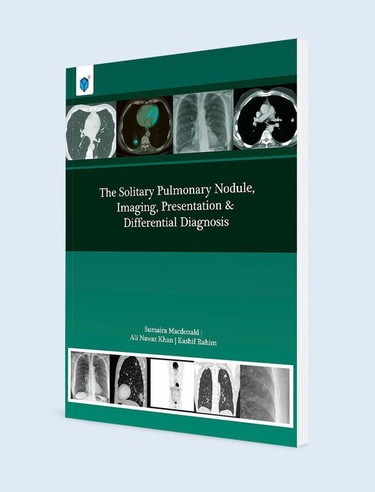THE SOLITARY PULMONARY NODULE, IMAGING, PRESENTATION & DIFFERENTIAL DIAGNOSIS